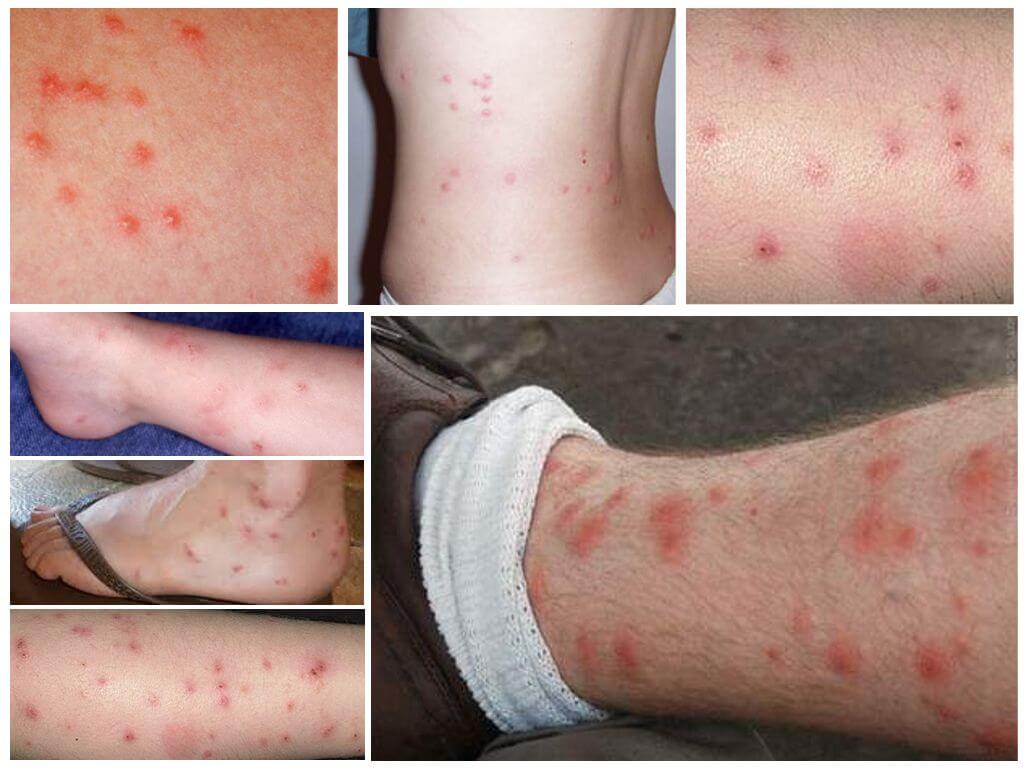 How flea bites look on human skin photo
