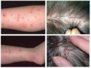 Flea and Lice Bites