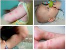 Flea bites in a child