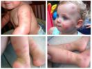 Allergy to bedbugs in children