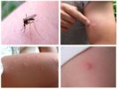 Mückenstiche