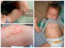 Bedbugs in children