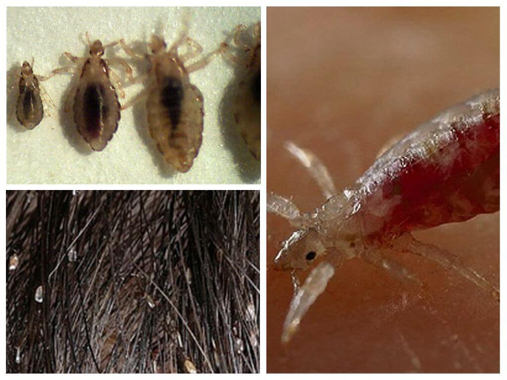 How lice and nits are transmitted
