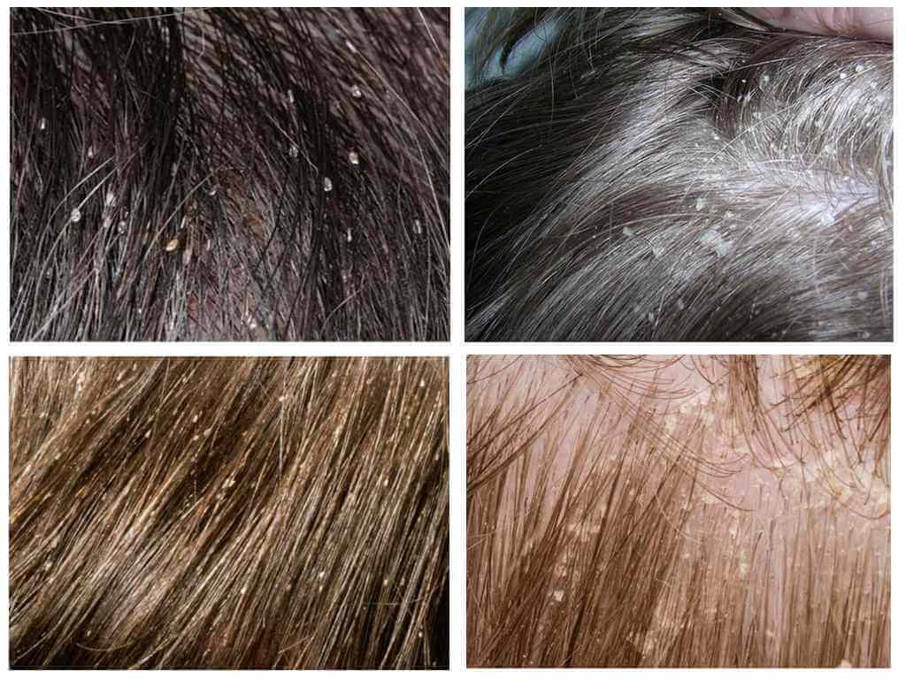 Lice in children in the hair