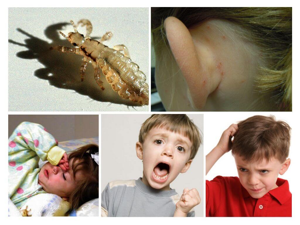 Wat is gevaarlijke pediculosis