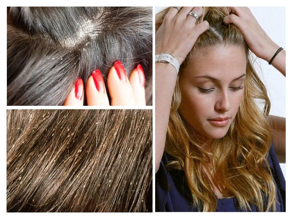 How to distinguish lice and nits from dandruff