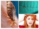 Ways of infection with lice