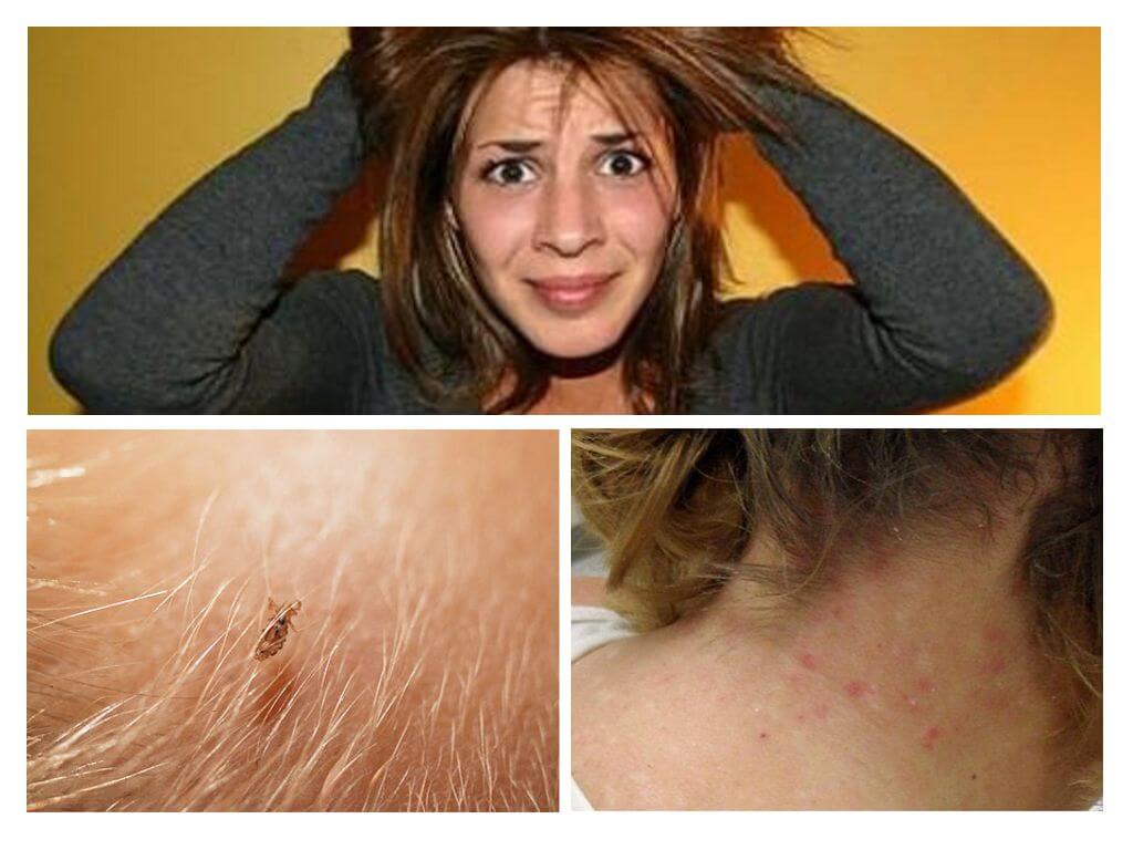 Prevention of lice and scabies
