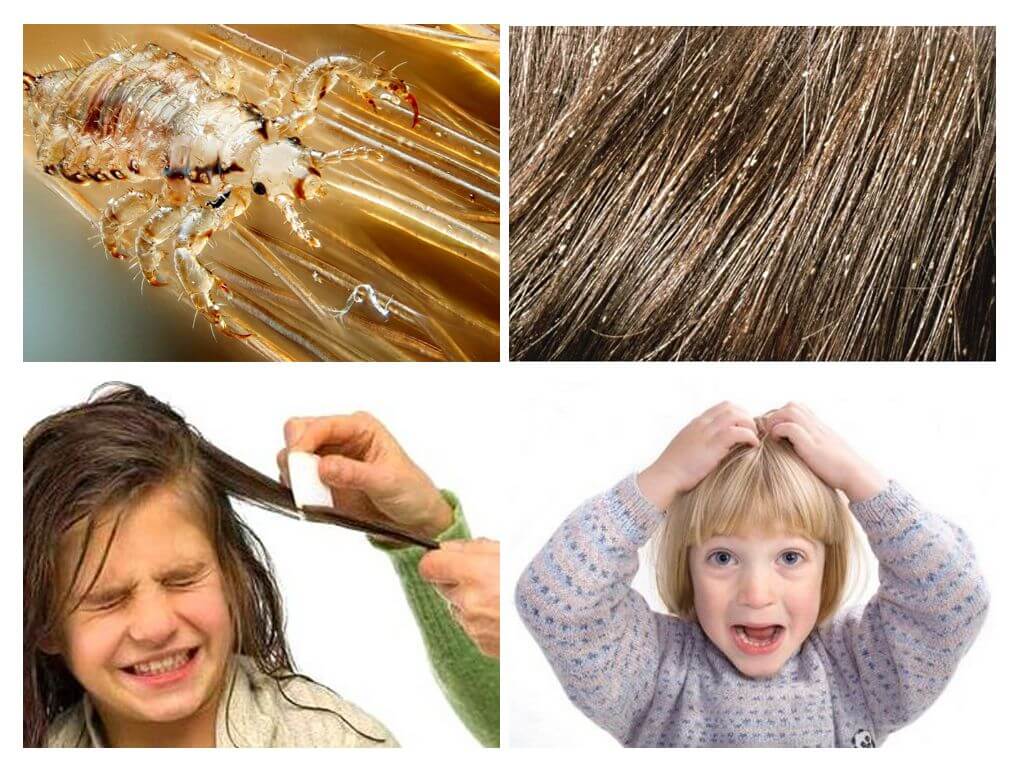 What to do if a child has lice