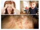 The consequences of lice