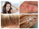 Signs of Lice