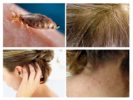 Symptoms of Pediculosis