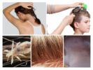 Signs of Lice