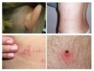 Appearance of bites of various pests