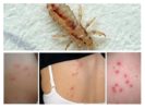 Body Lice Bites
