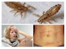 Lice diseases