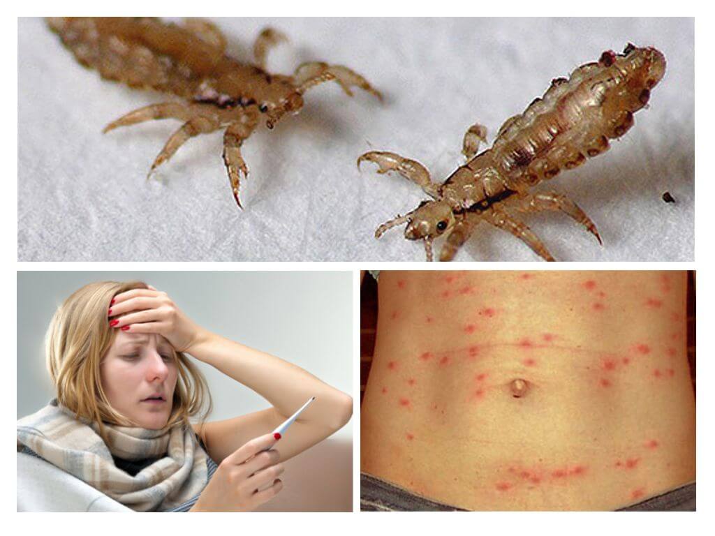 What diseases do lice carry?