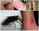 Insektenstich auf einem menschlichen Körper