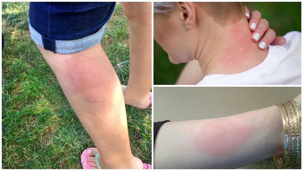 Treatment of allergies to mosquito bites in an adult and a child