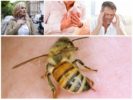 Důsledky včelího bodnutí