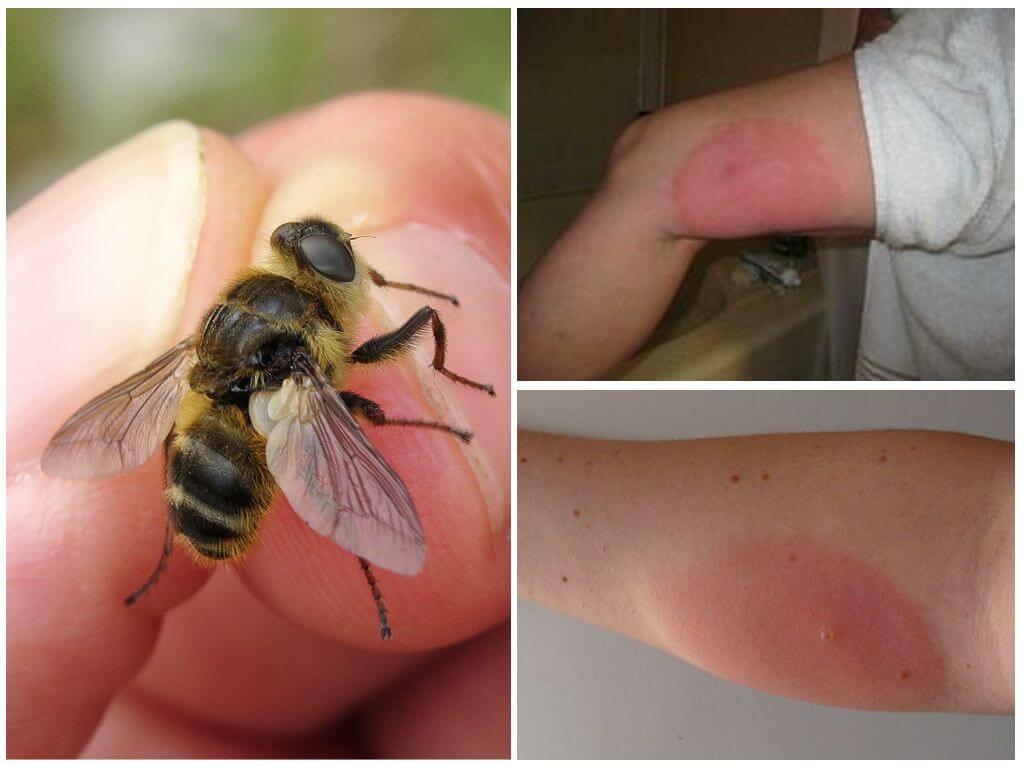 What to do if the bite of the gadfly is swollen and reddened