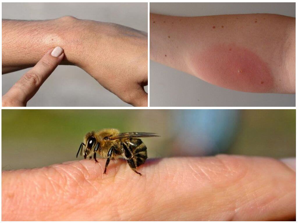 An allergic reaction to a bee sting, what to do