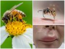 Piqûre d'abeille sur la lèvre