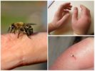 Mal d'une piqûre d'abeille
