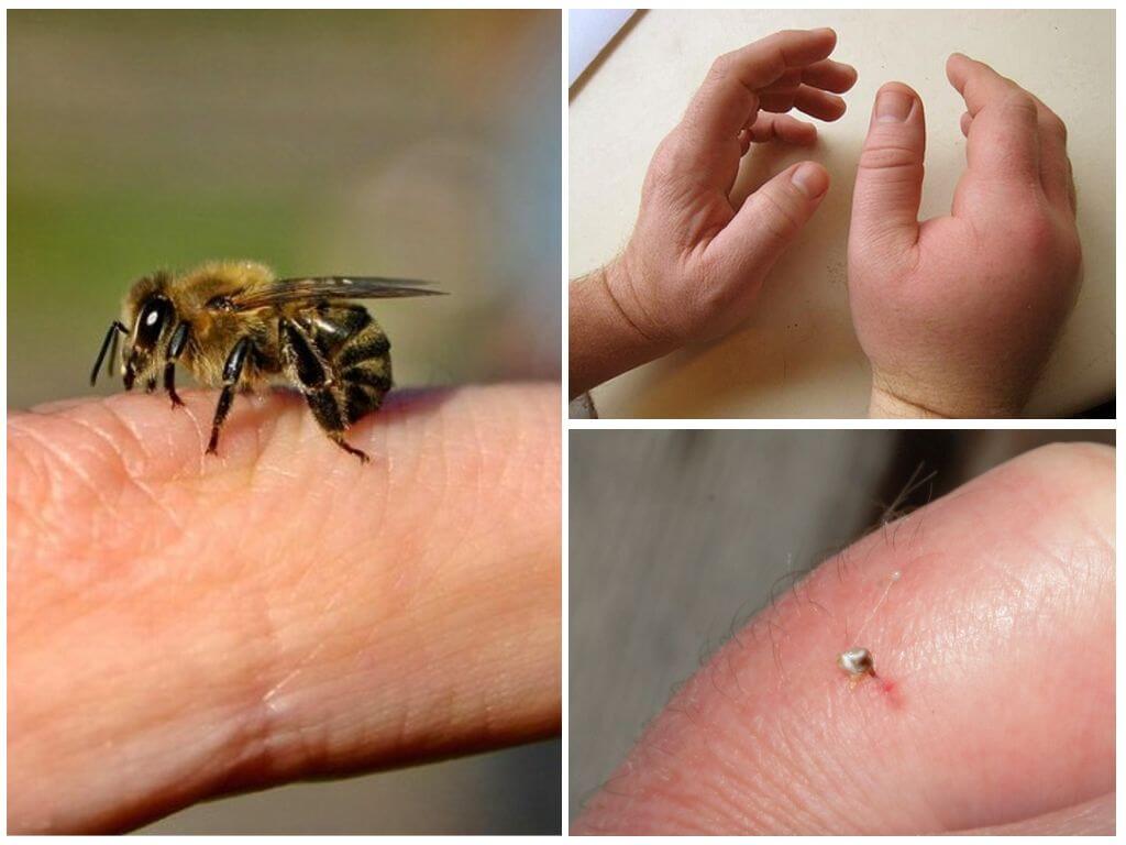 What is a bee sting useful for a person