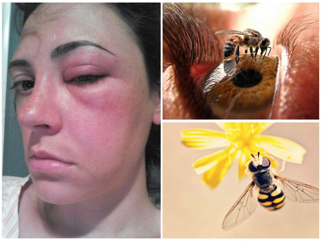 What to do if a bee bit in an eye and it was swollen