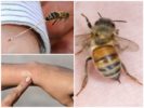 The benefits of a bee sting