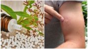 Homeopatické lieky na negatívnu reakciu na uhryznutie komárom