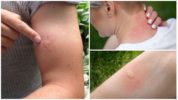 Typický klinický obraz uhryznutia komára
