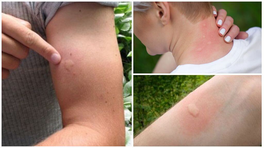 How to relieve swelling and itching from mosquito bites in a child and an adult