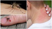 Mückenstich
