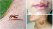 Malaria and tularemia from mosquitoes