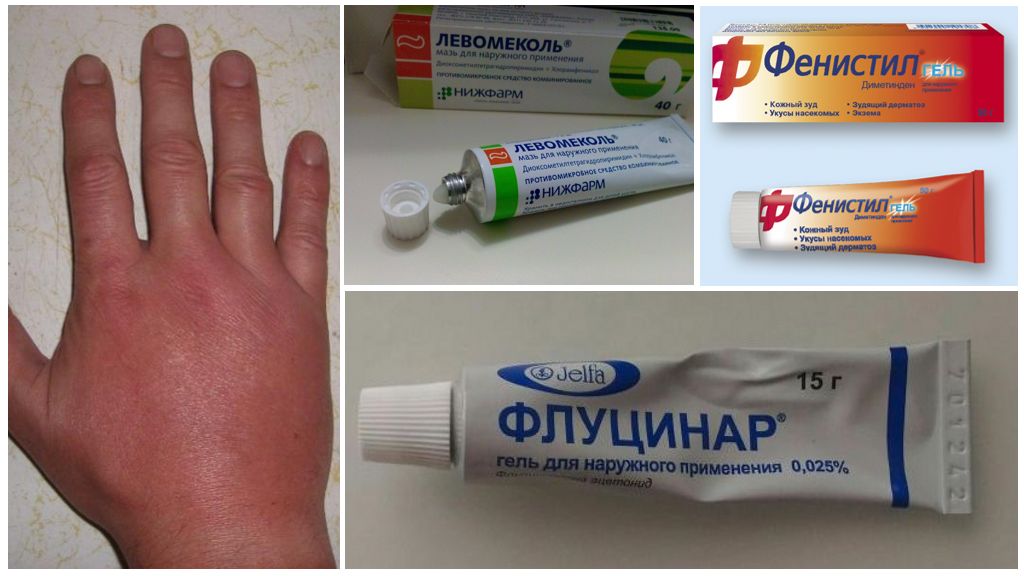 Nach einem Mückenstich ist der Arm eines Kindes oder Erwachsenen geschwollen, Erste Hilfe