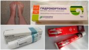 Treatment of edema with hormonal drugs