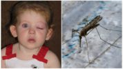 Hævelse af et barns øje fra en myg bid