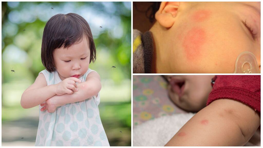 Myg bider på huden på en voksen eller et barn