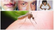 Possible consequences of a bite of a malaria mosquito