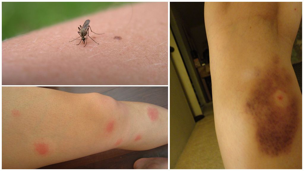 Why do bruises remain after mosquito bites?