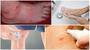 Actions for blisters from mosquito bites