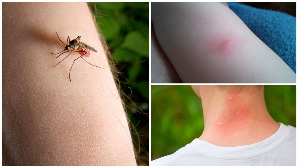 What is the difference between a mosquito bite and a bug or tick bite