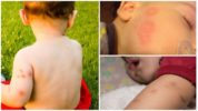 Mückenstiche bei Kindern