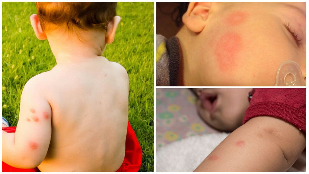 Means for children after mosquito bites