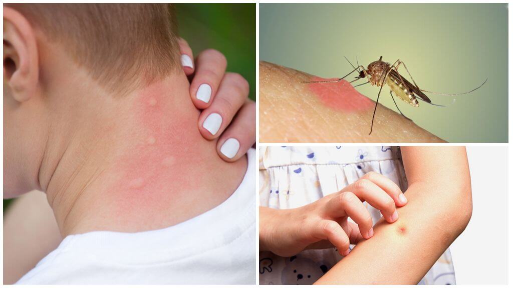 Pourquoi les moustiques piquent les démangeaisons