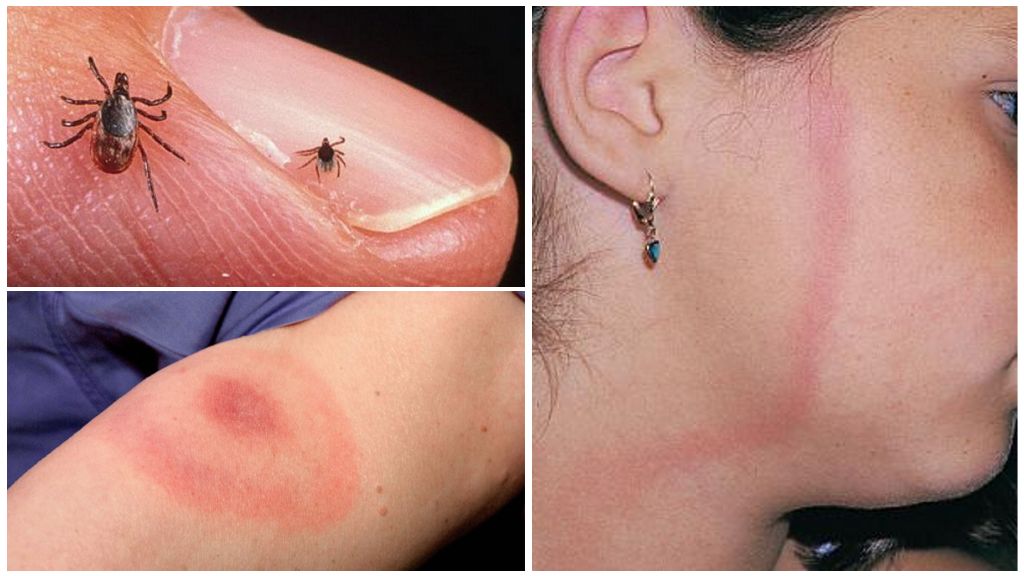 Tick-borne borreliosis symptoms, consequences and prevention in adults