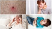Initial signs of tick-borne diseases