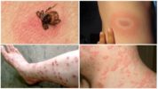 Tick-borne diseases